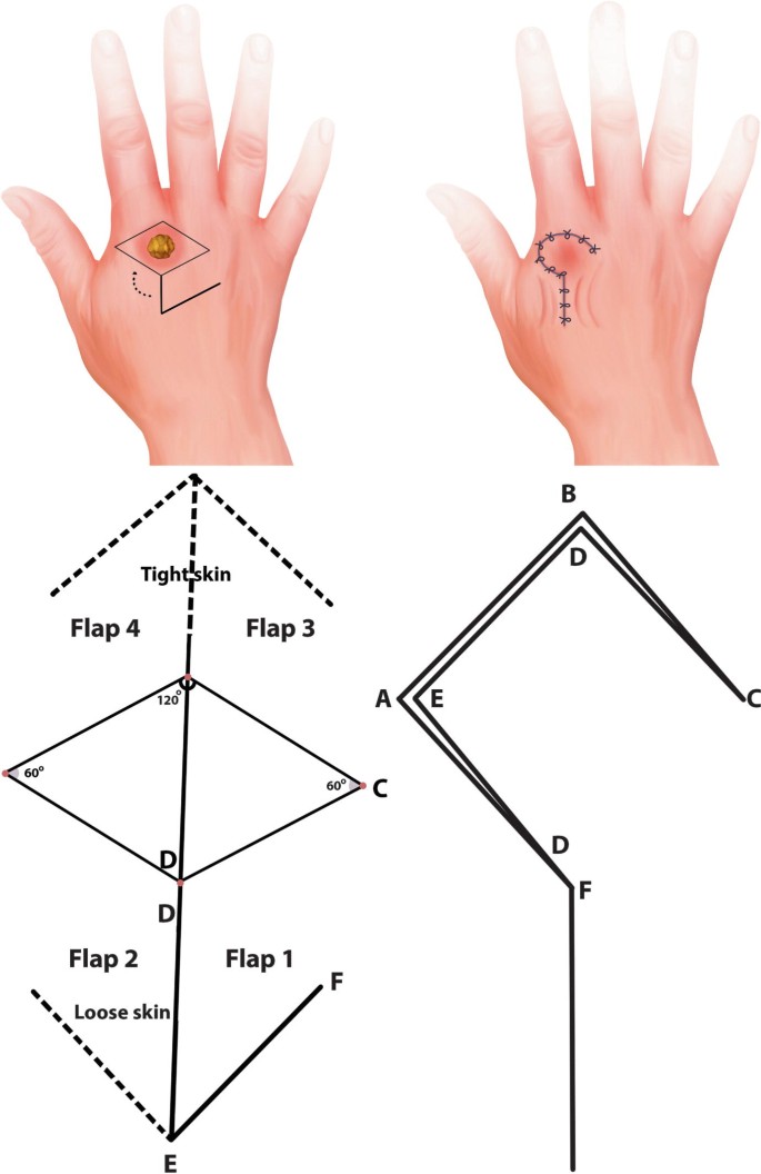 Limberg (Rhomboid) Flap | SpringerLink