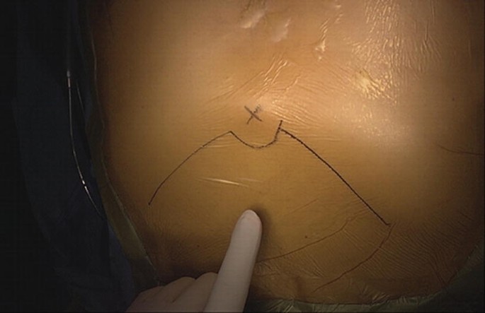 A photo of skin marking below the xiphoid process where the incision will be made. The marking has a wide upside-down fan shape and an X mark on top.