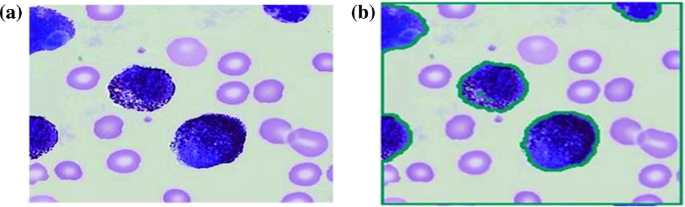 2 microscopic images of blood samples. The image on the left displays the unaffected blood cells represented as blue spots. The image on the right displays the blood cells affected with leukemia represented with green covering outside the blue spots.