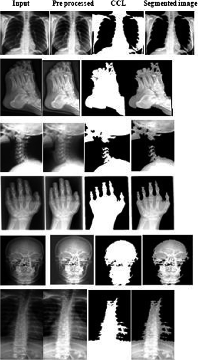 A chart of x-rays in four columns and six rows. The column headers are input, pre-processed images, C C L, and segmented images. The row entries from columns 1 to 4 are as follows. Row 1: chest; row 2: foot; row 3: hand; row 4: face; row 5: neck; and row 6: spine.