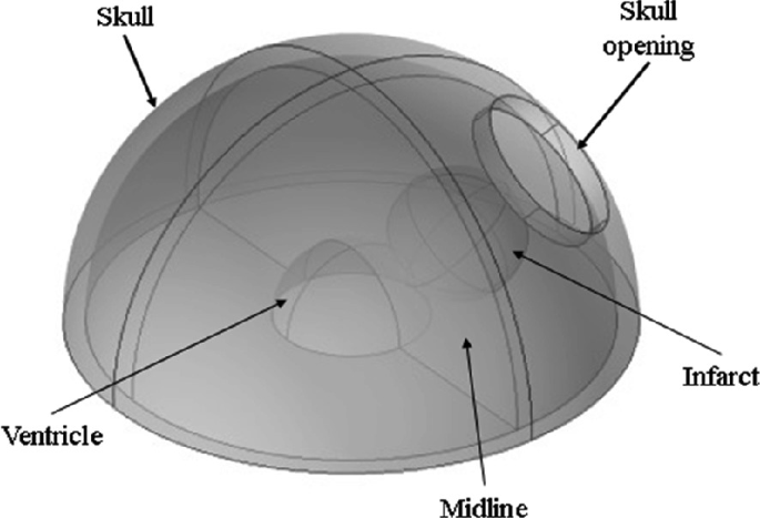 Illustration of the idealized 3 D brain model. It is hemispherical in shape, with the interior parts visualized, with the outer covering labeled skull, and the circular opening on the skull is labeled skull opening. The walls dividing the interior of the skull are labeled midline, the structures within the skull are ventricle, and infarct.