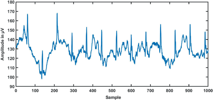 A graph of hypertension-associated E C G signals for a duration of 5 minutes. It plots the amplitude in micro volts versus samples. Values are estimated. (0,130), (50,141), (150, 100), (200, 138), (250, 140), (300, 121), (400, 145), (500, 130), (600, 145), (700, 131), (800, 118), (900, 158), (1000, 126).