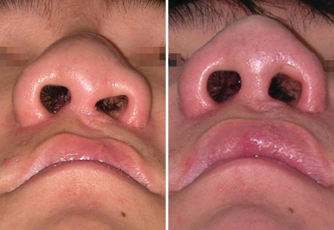 Two close-up photographs of nose and lips. Image A has unilateral cleft nasal deformity. The right nostril is narrower than the left. A cleft is visible on the right portion of the upper lip. Image B is the repaired version after secondary rhinoplasty. The nostrils are now symmetrical and the upper lip is more prominent than in Image A.