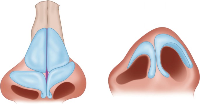 Two model images of the nose with unilateral cleft deformity. Image A is a front view of a nose, while Image B is a close-up of nostrils. The nostrils are asymmetrical and a little bigger than usual.