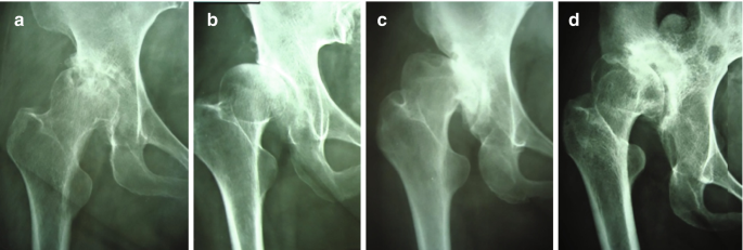 4 radiographs of dislocation of the femoral head. It has 4 types of Crowes with different subluxation.