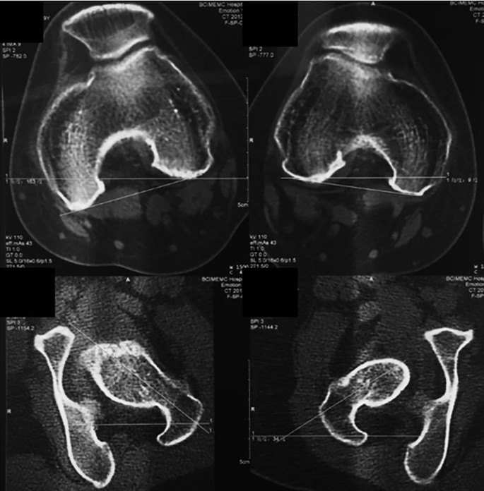 4 computed tomography scans for the measurement of femoral anteversion. Each image has horizontal lines.