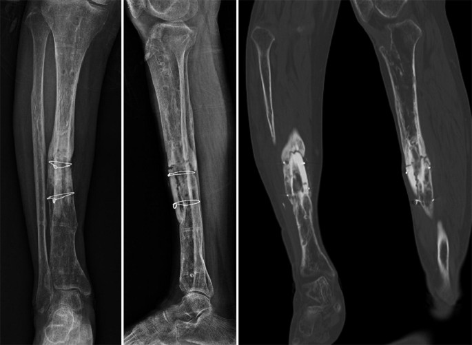 Plate osteosynthesis combined with bone cement provides the