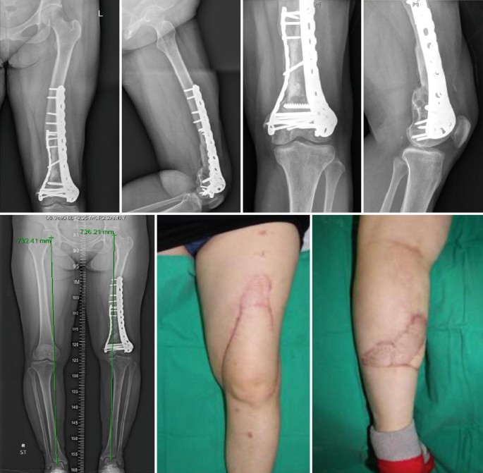 Plate osteosynthesis combined with bone cement provides the