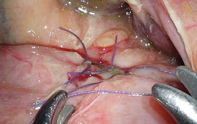 With the needle held with its concavity curved downward, a suture is tied using the intracorporeal method.