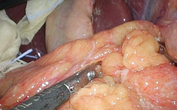 An image of a peritoneum fold connecting the stomach to other abdominal organs is restored with a thin, sickle-shaped, fibrous structure connecting the anterior part of the liver to the ventral wall of the abdomen.