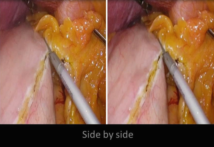Two images of a similar apparatus were inserted into a yellowish tissue. A text that reads side by side is provided below.