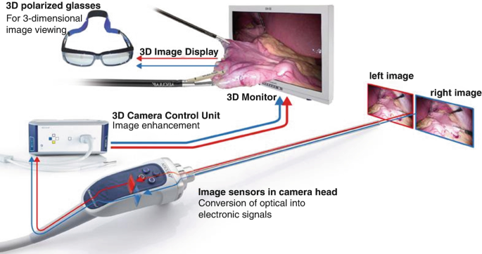 An image of the camera head of image sensor. It displays left and right images. The head is connected to 3 D camera control unit, which enhances the image in 3 D monitor. The 3 D image is displayed and can be viewed by using 3 D polarized glasses.