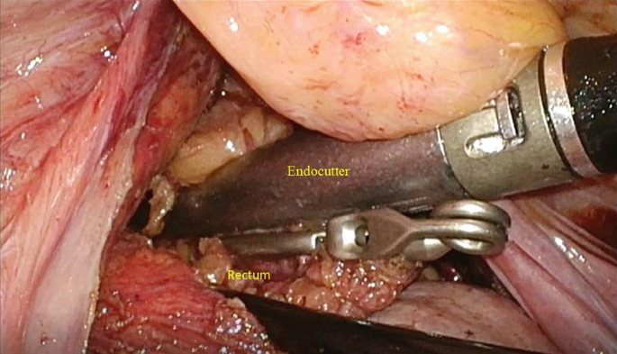 An endocutter is inserted into the rectum in this image.