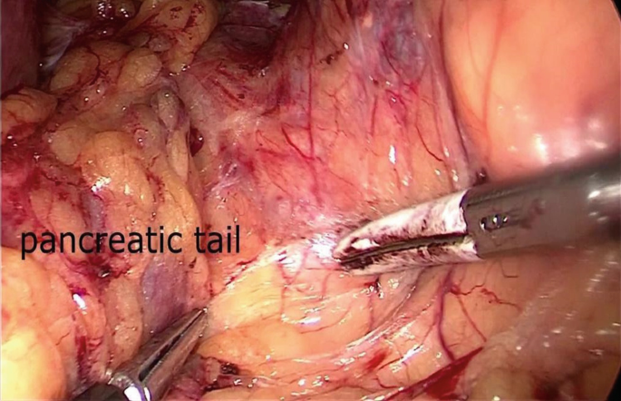 Image of the medial rotation of the pancreatic tail. The thin tip of the pancreas on the left side of the abdomen is in close proximity to the spleen.