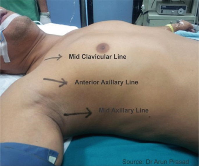 A photograph of a patient in the supine position exhibits the anatomical landmarks for port placement. The midclavicular line, anterior axillary line, and mid axillary line are noted.