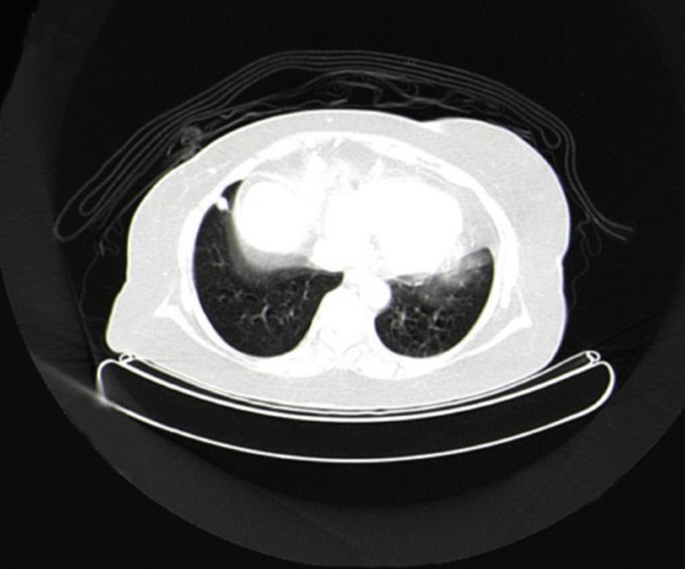 A high-resolution computed tomography image of a solitary lung lesion.