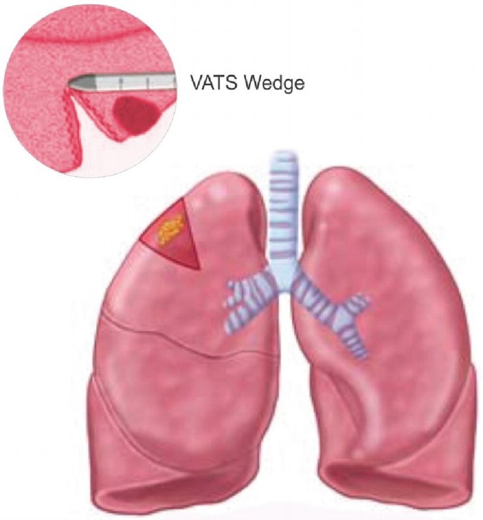 An illustration of the lungs depicts the upper lobe of the left one depicts a triangular marking. A magnified view of this area reveals a wedge resection on the overlying pleural adhesion.