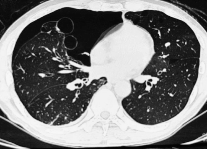 A high-resolution computer tomography image depicts the presence of a bulla in the lungs. C T scans help to identify the size and progress of the bulla.