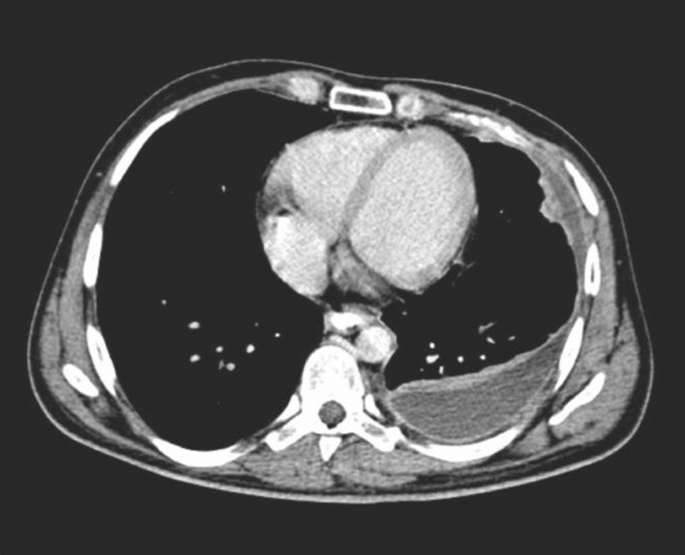 A high-resolution computed tomography image depicts the presence of empyema in the lungs.
