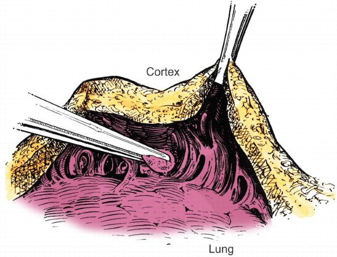An illustration depicts the use of a clamp to peel off the cortex and a decortication forceps to remove the fibrinous material from the cavity.