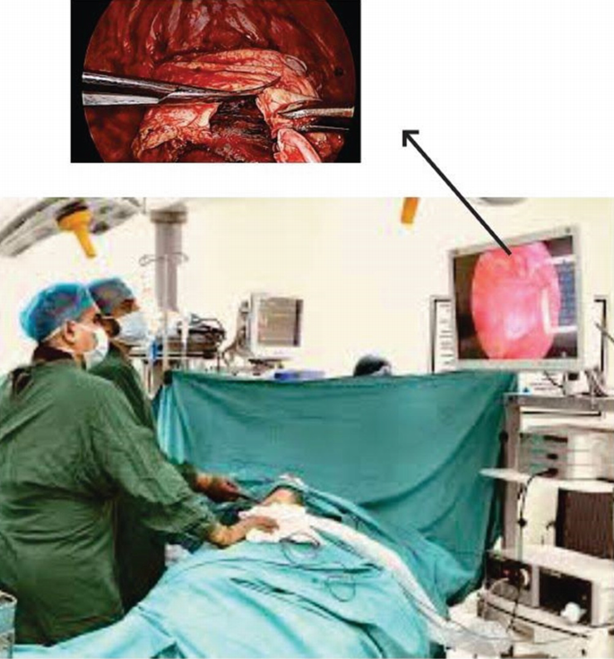 Two photographs depict the decortication of the lungs. The photo at the bottom depicts surgeons assessing the image on the monitor. The photo above is the one on the monitor, enlarged and more detailed.