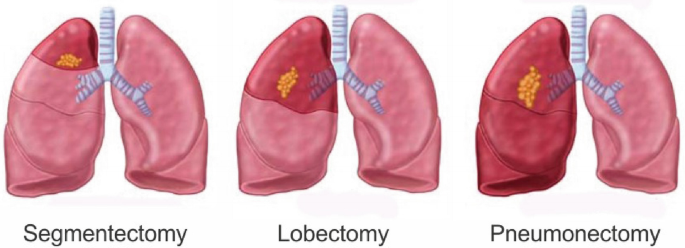 Three illustrations of the types of anatomical lung resection where a part of the lung is shaded to depict the part to be removed. From left to right, they are as follows, segmentectomy, lobectomy, and pneumonectomy.