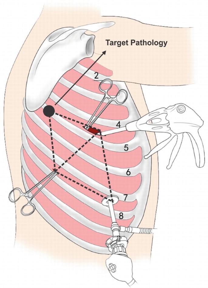 An illustration depicts the baseball diamond principle of port placement. The rationale behind this is to orient the camera and all instruments to face toward the target pathology.