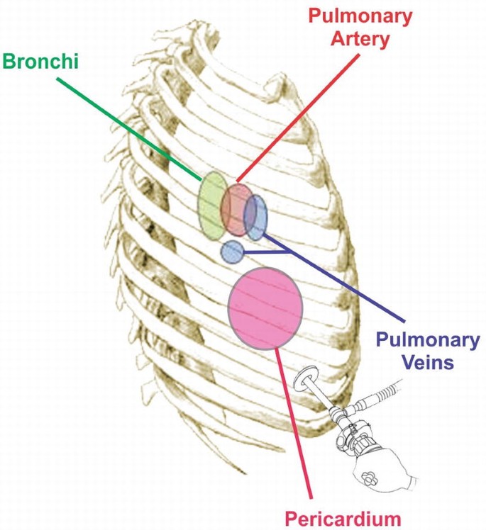 An illustration of the hilar anatomy with four labeled parts, pulmonary artery, bronchi, pulmonary veins, and pericardium.