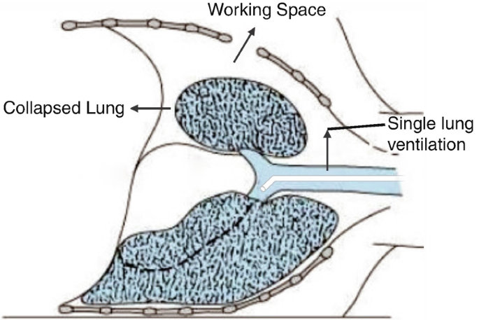 An illustration of the double-lumen single lung ventilation depicts the insertion of the endotracheal tube below the collapsed lung. The working space is also indicated above the collapsed lung.