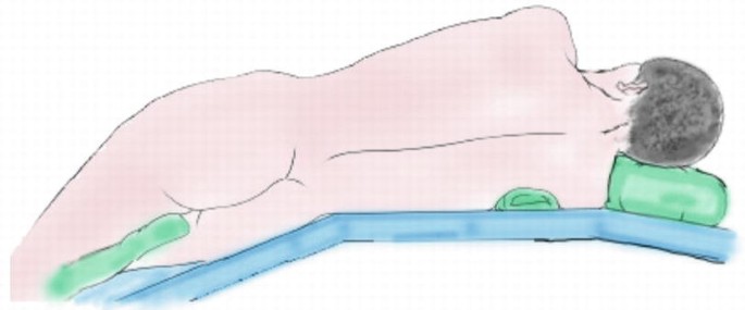 An illustration of an undressed patient lying in a lateral decubitus position on a flexed operating table. The patient's head is propped up on a bolster.