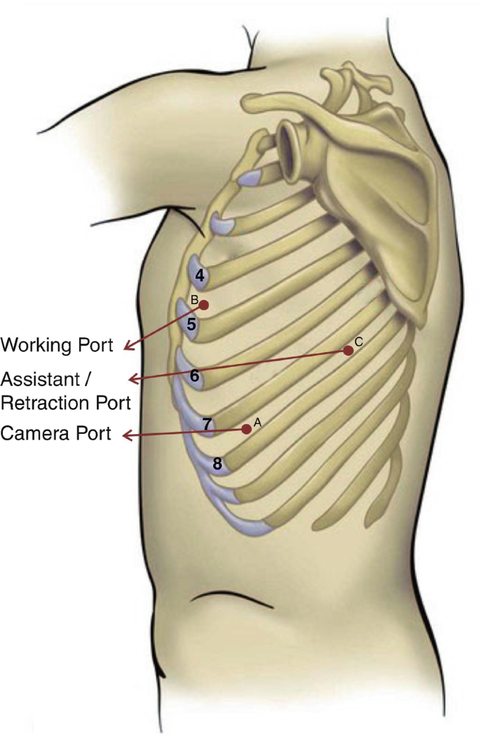 An illustration indicates the position of the three port placements or incisions in the intercostal spaces. The working port, retraction port, and camera port are labeled.