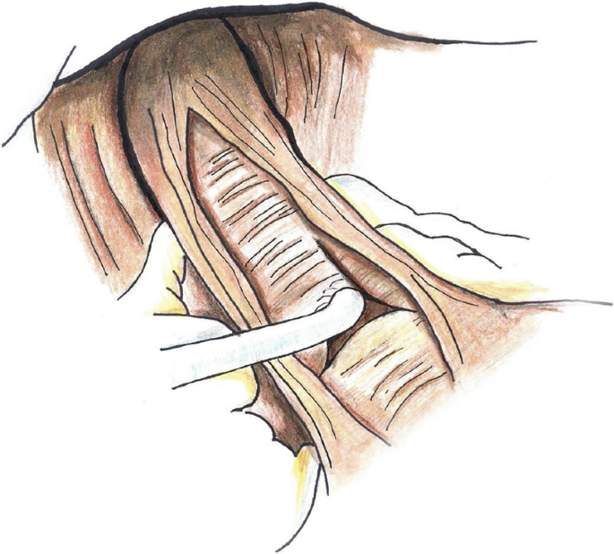 An illustration of the process of myotomy that involves circular muscles and muscle fibers.