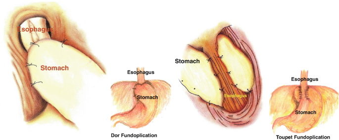 Four illustrations of fundoplication procedures on the stomach and esophagus. The first and second image illustrates dor fundoplication, while the third and fourth illustrate toupet fundoplication.