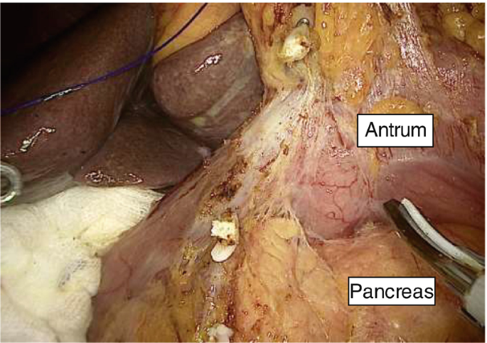 A photograph of the right gastroepiploic vessels after being clipped. The antrum and pancreas are labeled.