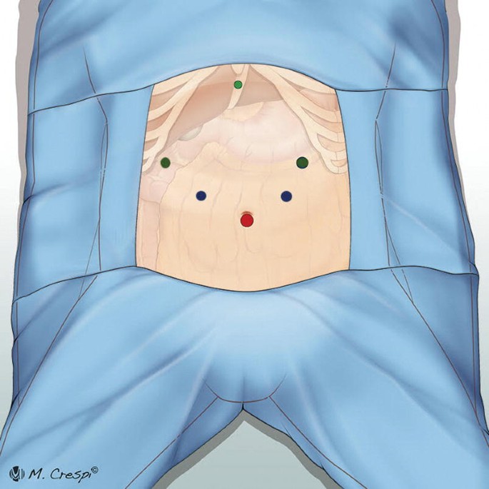 An illustration of a patient's exposed stomach over surgical drapes. There are six points depicted.