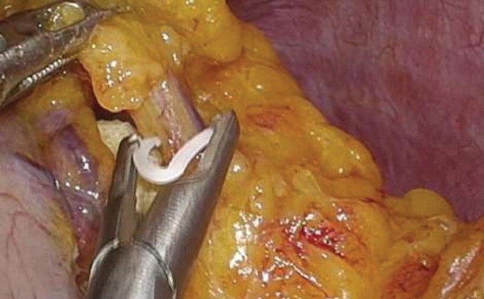 A photograph of the short gastric vessels being dissected.