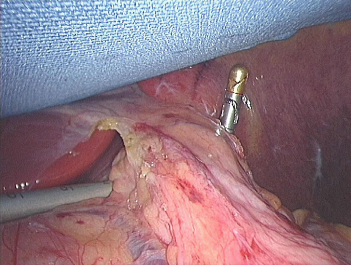 A photograph of the completed tunnel behind the stomach extending the left of the lower or hind limb using an endoscopic instrument.