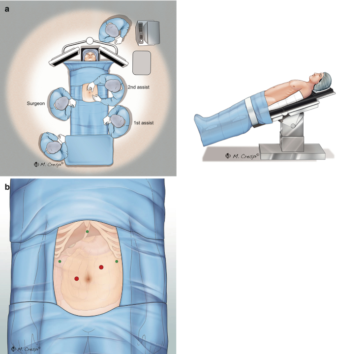 Image A, located on the upper left side is an operation set up where the patient on a hospital bed is surrounded by surgeons, while B, is a patient lying on an inclined operating bed. Image C is an exposed area for surgery with ports placed.