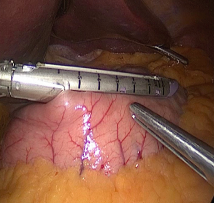 A photograph of a surgical procedure to create a surgical pouch.