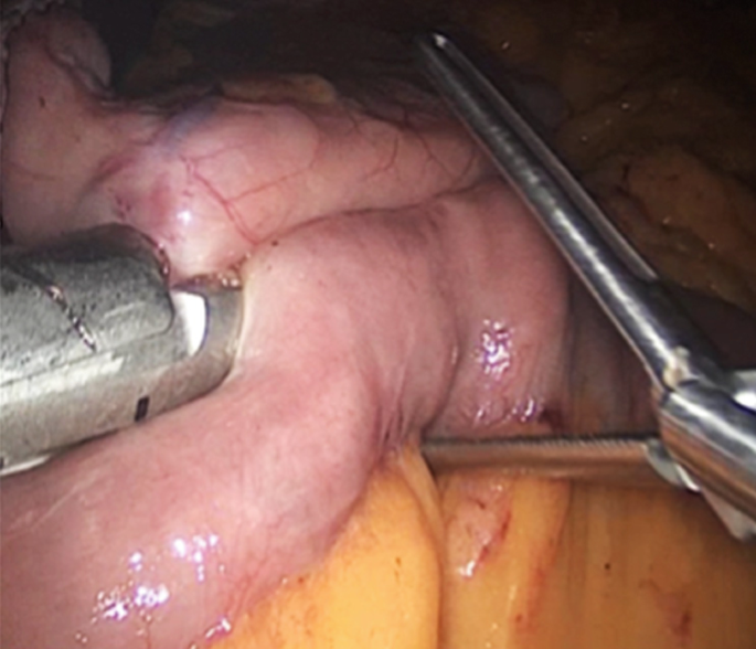 A photograph of a surgical procedure step named Gastrojejunostomy.