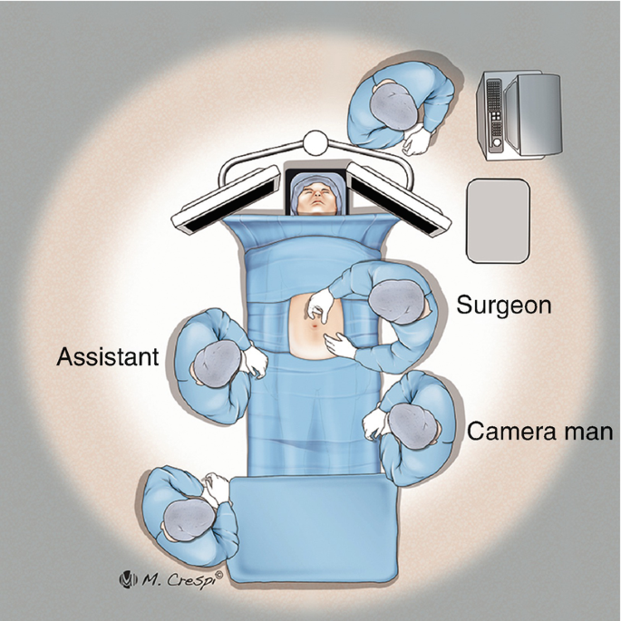 An illustration of a patient lying down on the operating table with his stomach exposed. The surgeon and cameraman are on the right of the patient, on the left are the assistant and another person, and above the head of the patient is a person in front of a machine.