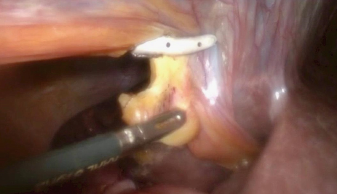 A photograph of the falciform ligament being divided by a surgical instrument.