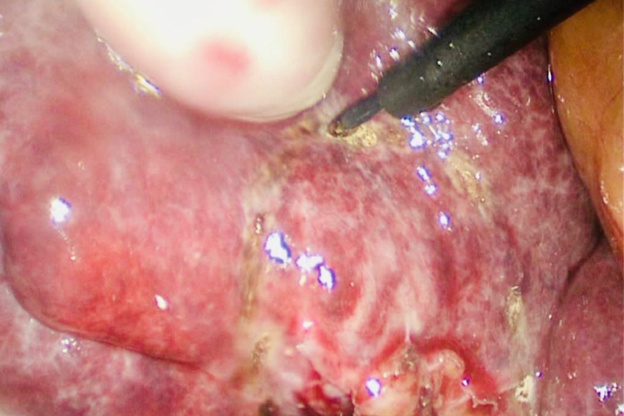 A photograph of the liver parenchyma being marked with a surgical device with a hook.
