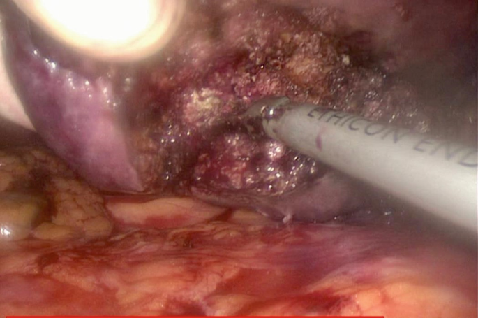 A photograph of the tumor being deeply probed and removed. A harmonic scalpel is used.