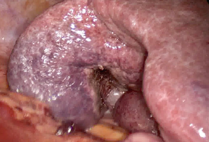 A photograph of the liver segment after cutting out the tumor.