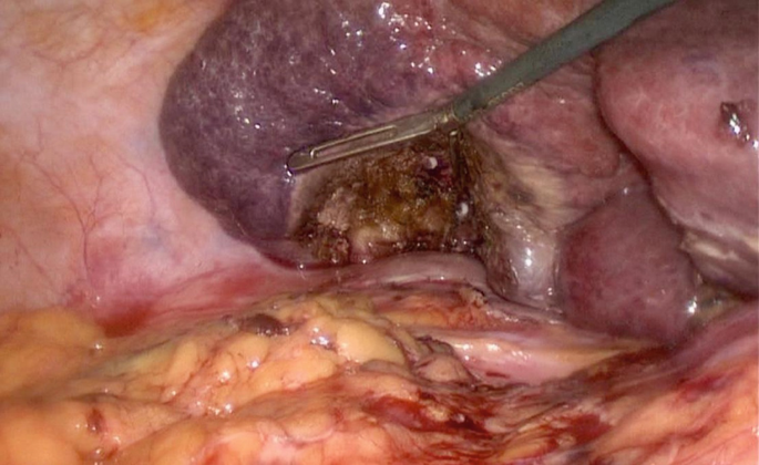 A photograph of the hollow part where the tumor came from being packed with a haemostatic agent. A surgical device is used to ensure that the agent is applied correctly.
