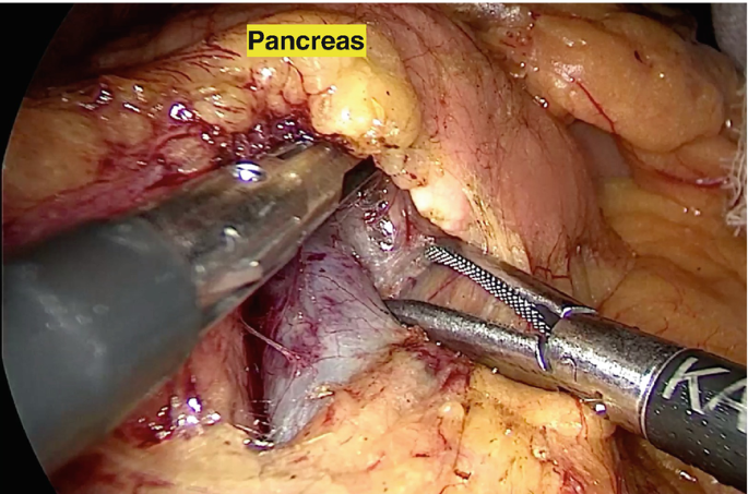The image from the surgery with two retraction devices which have managed to expose the pancreas in the abdomen of the patient.