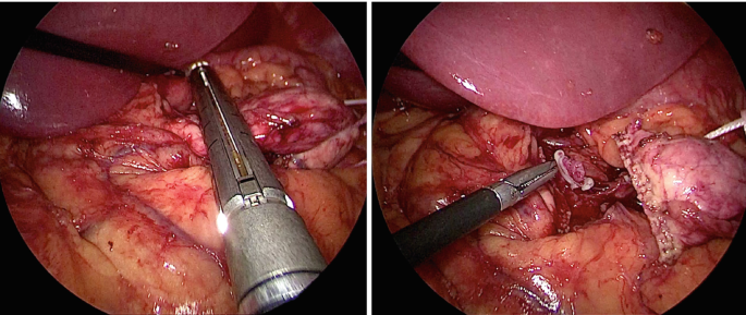 The image from a surgical procedure with a stapler is used to connect the pancreas. The adjacent image has ligation done and now the structures are being secured at their original places. A part of an organ can be seen rest is the intestines and the pancreas.