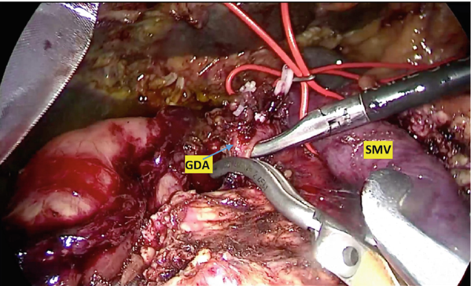 An intraoperative photo of the abdomen with a small mesenteric vein and gastric duodenal artery lying in close proximity is shown.