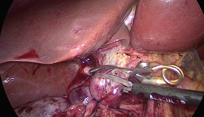 An intraoperative photo of the abdomen in which the bile duct is clamped, and other gastrointestinal organs are shown.